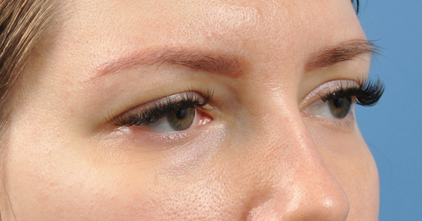 Blepharoplasty