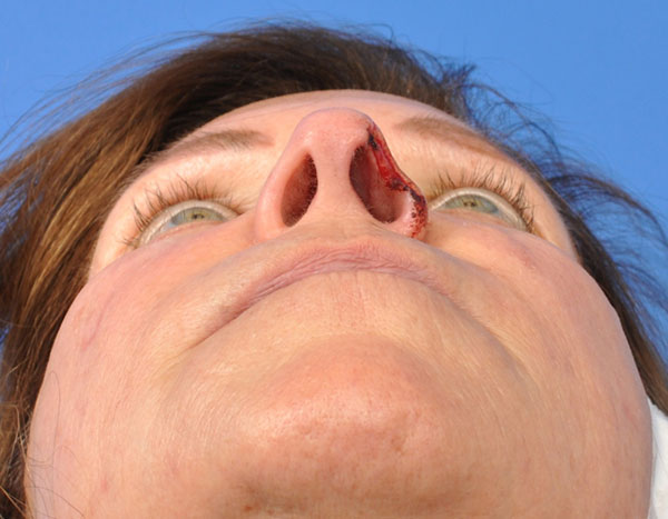 Nasal Reconstruction