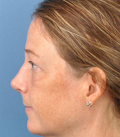 Rhinoplasty