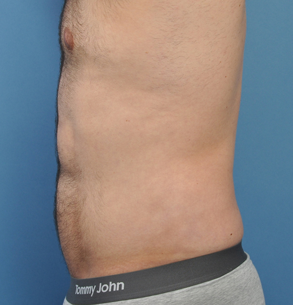 Male Liposuction