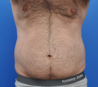 Male Liposuction