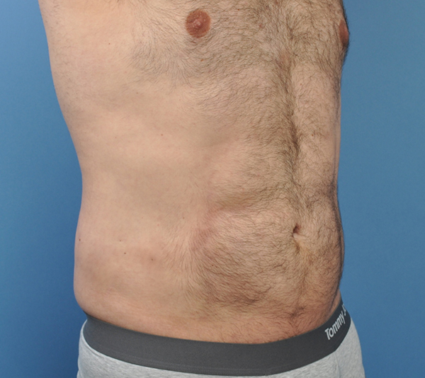 Male Liposuction