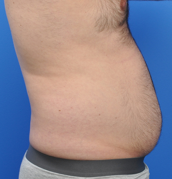 Male Liposuction