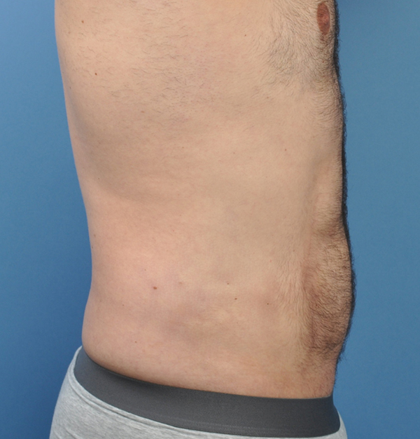 Male Liposuction