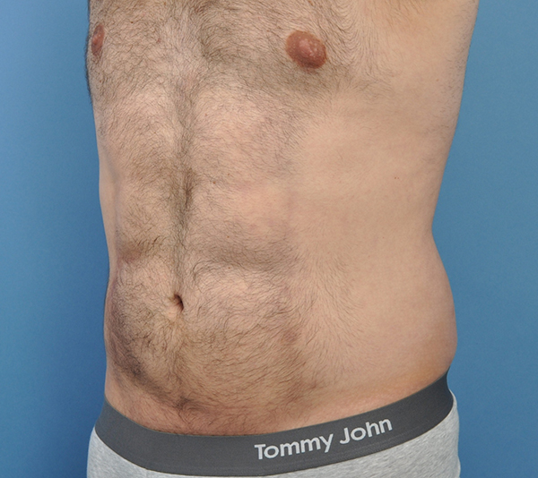 Male Liposuction