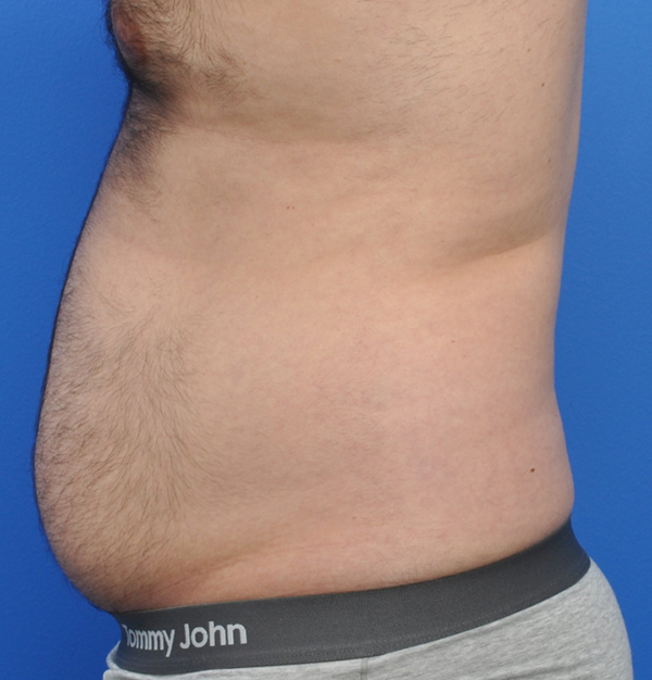 Male Liposuction