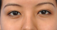 Blepharoplasty