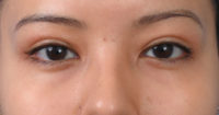 Blepharoplasty