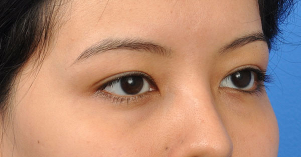 Blepharoplasty