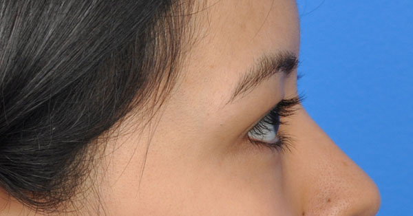 Blepharoplasty