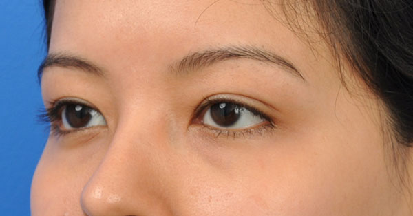 Blepharoplasty