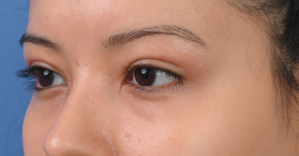 Blepharoplasty