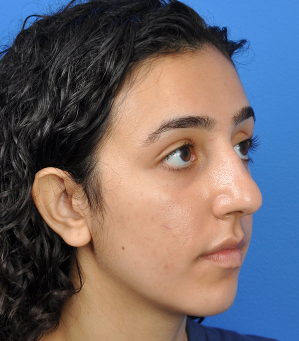 Rhinoplasty