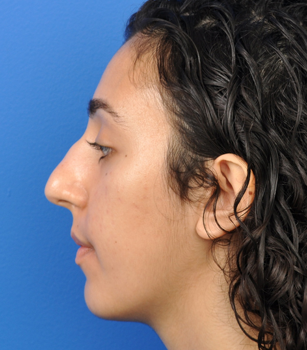 Rhinoplasty