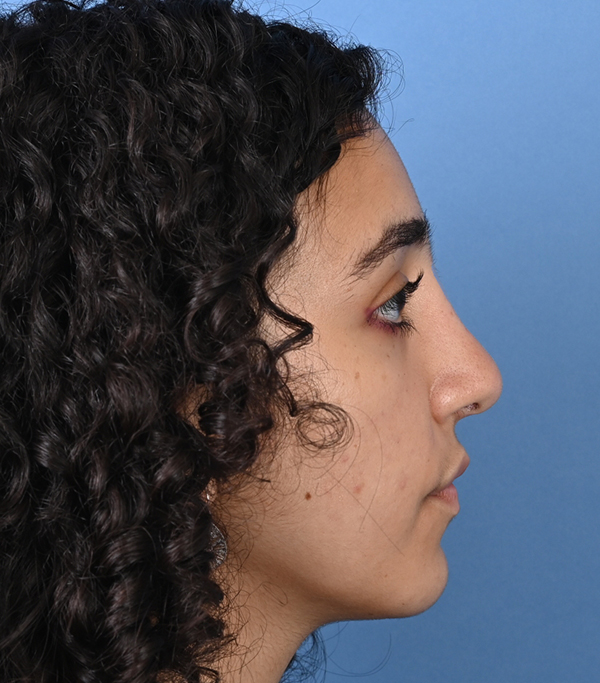 Rhinoplasty