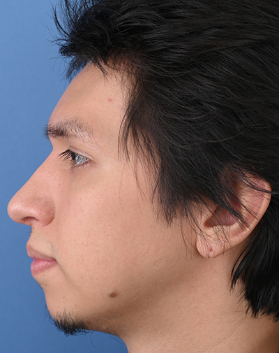 Male Rhinoplasty