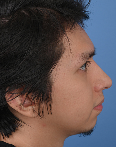 Male Rhinoplasty