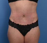 Abdominoplasty