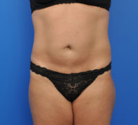 Abdominoplasty