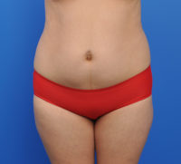 Liposuction