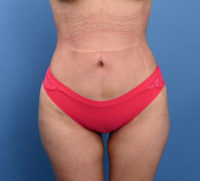 Liposuction