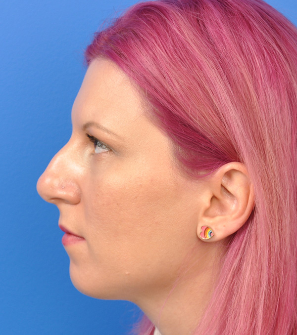 Rhinoplasty