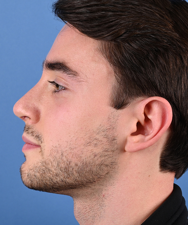 Male Rhinoplasty