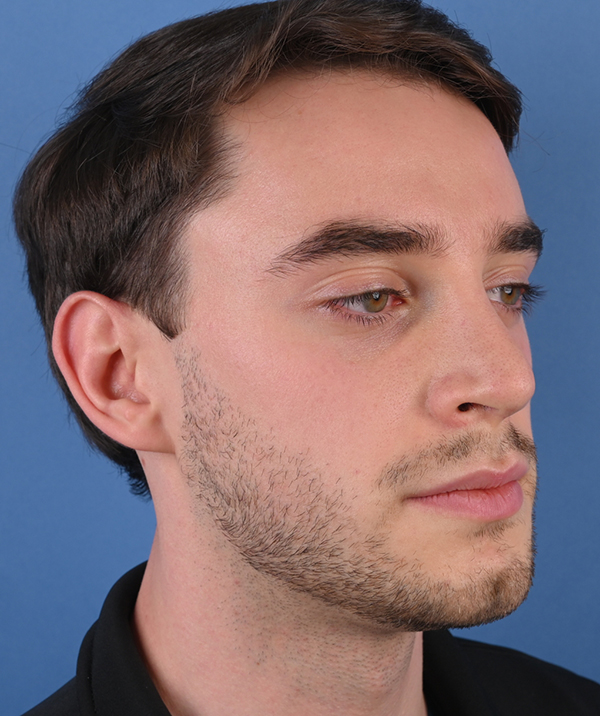 Male Rhinoplasty