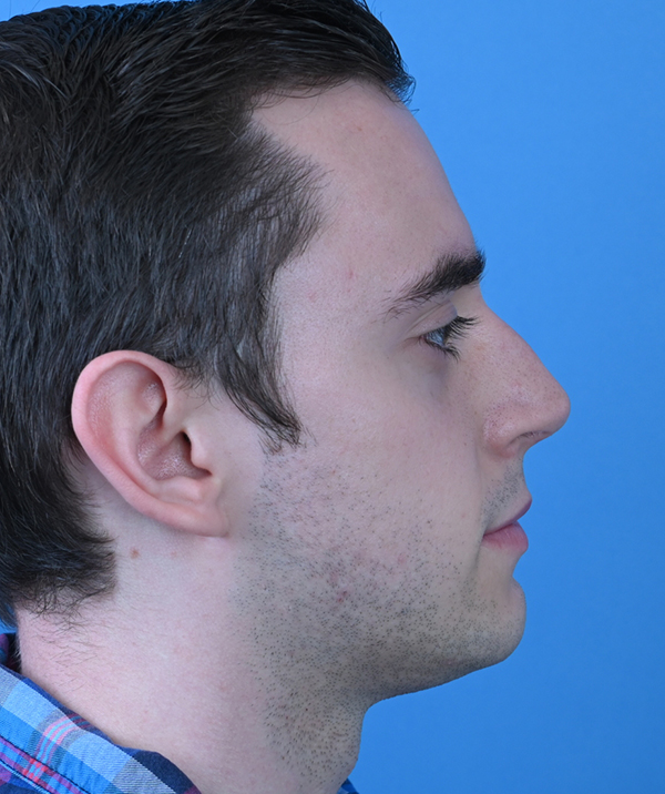 Male Rhinoplasty