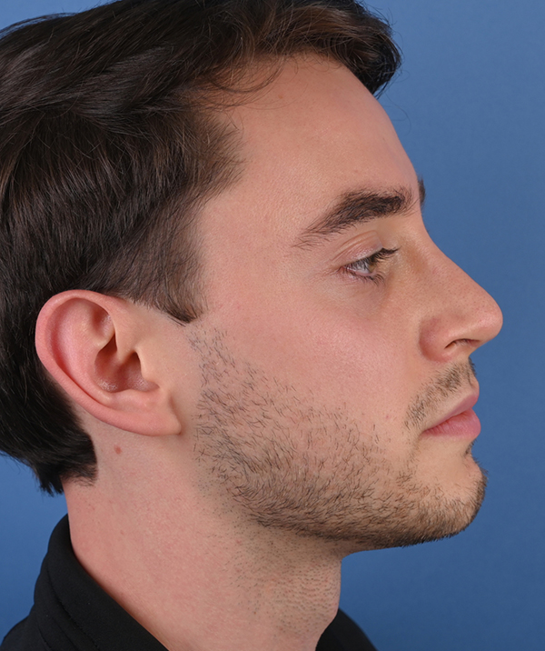 Male Rhinoplasty