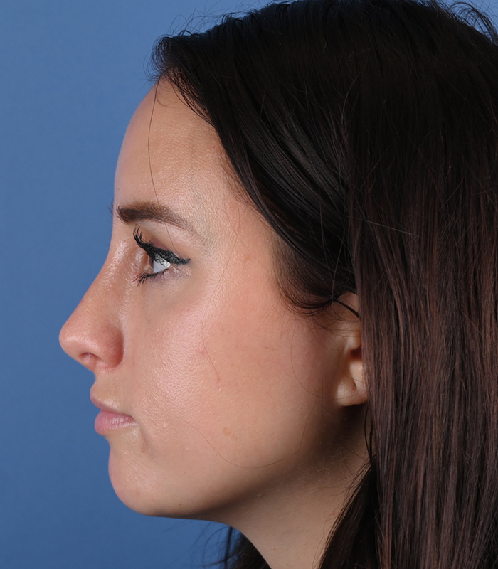 Rhinoplasty