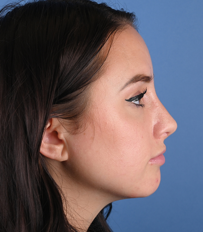 Rhinoplasty