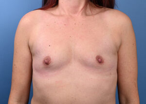 Breast Augmentation