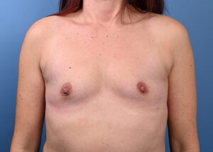 Before breast augmentation Front View