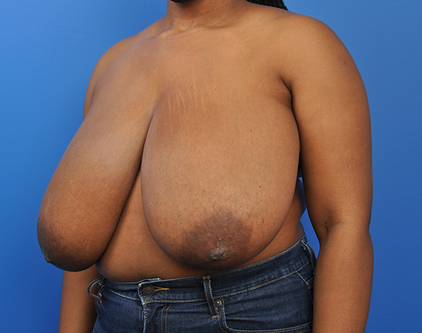 Breast Reduction