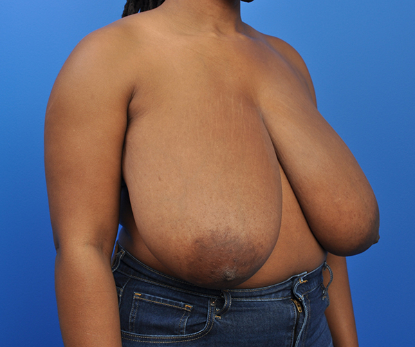 Breast Reduction