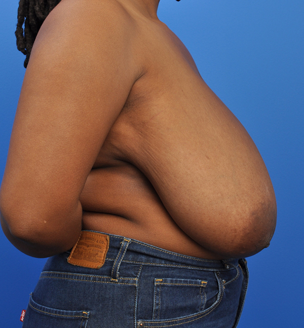 Breast Reduction