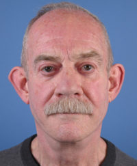 After facelift results for male patient