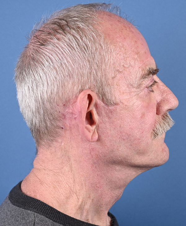 Male Facelift Before and After