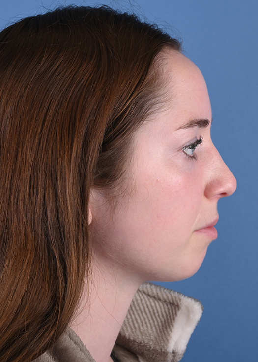 Genioplasty or Chin Augmentation Surgery Results Chicago