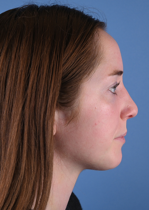 Genioplasty or Chin Augmentation Surgery Results Chicago