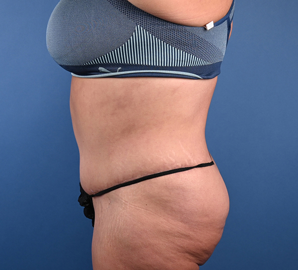 Abdominoplasty