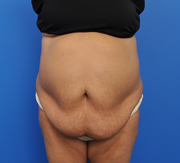 Abdominoplasty