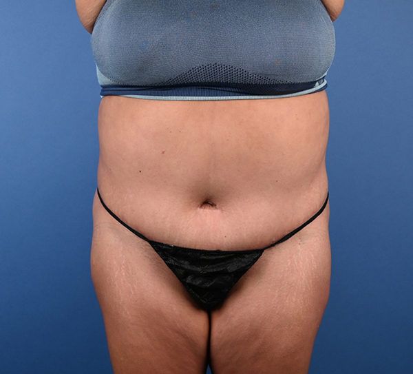 Abdominoplasty