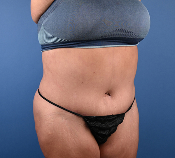 Abdominoplasty