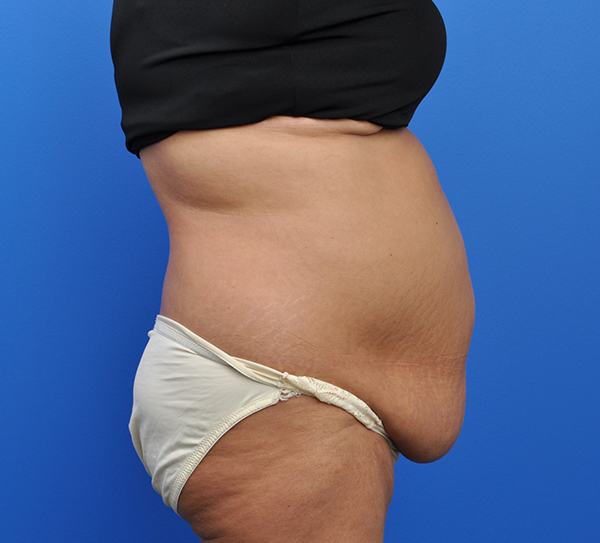 Abdominoplasty