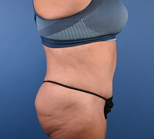 Abdominoplasty