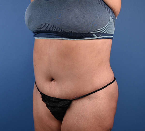 Abdominoplasty