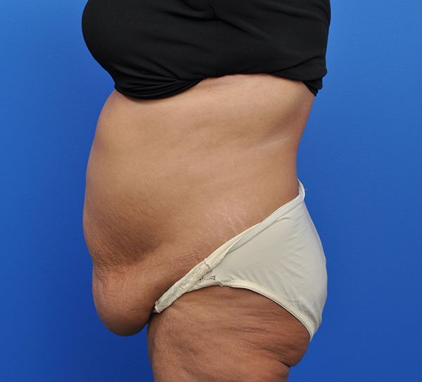 Abdominoplasty