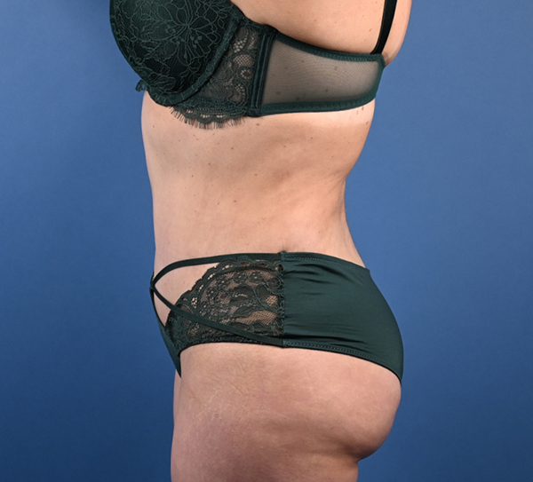 Abdominoplasty